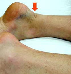 Der rote Pfeil zeigt die deutliche Delle im Bereich der Achillessehnenruptur