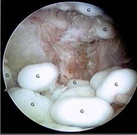 multiple freie Gelenkkörper (G) im Ellenbogengelenk mit begleitender Schleimhautentzündung