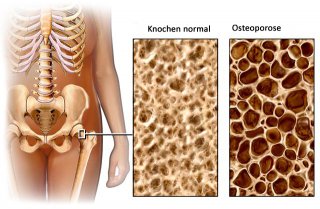 Vergleich gesunder-osteoporotischer Knochen