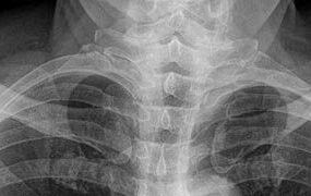 Röntgen-Panoramaaufnahme beider Schultereckgelenke mit Rockwood-3-Verletzung links (rot)